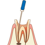 根管治療